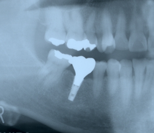 implant3