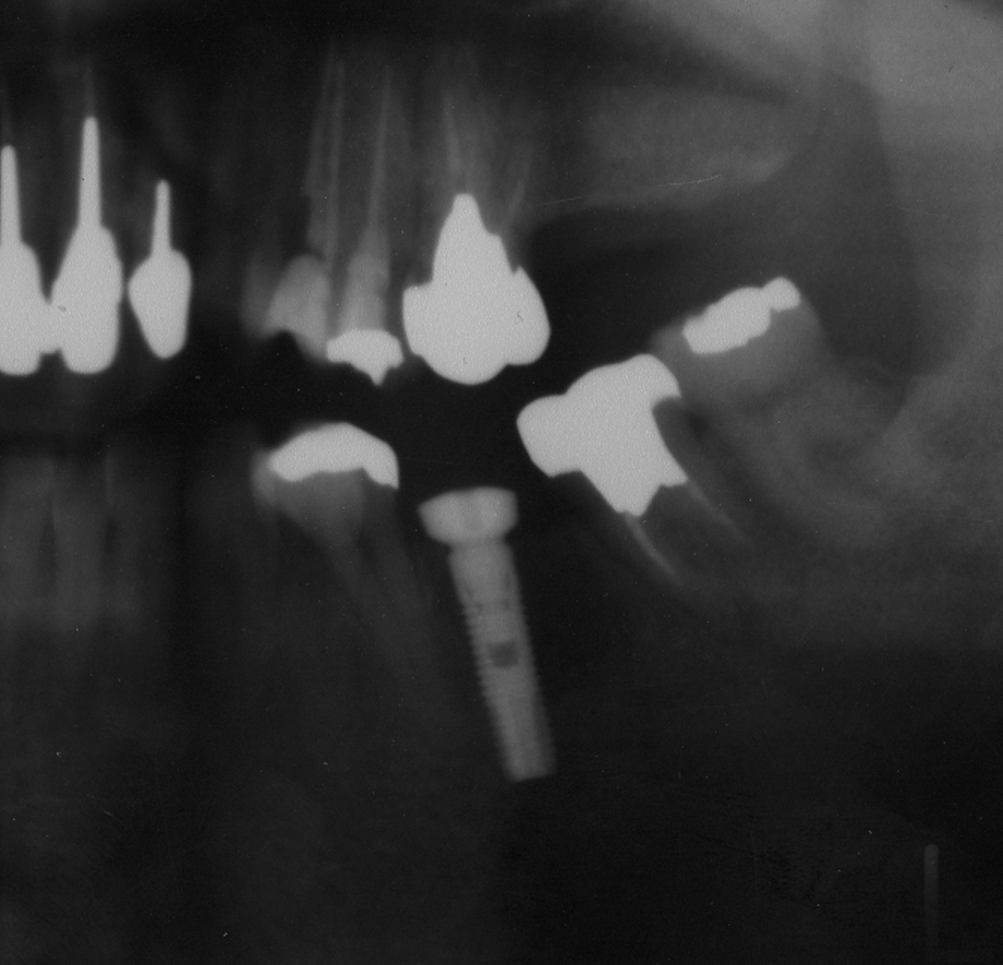 implant2