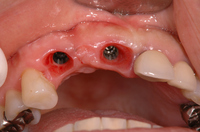 インプラント症例前歯
