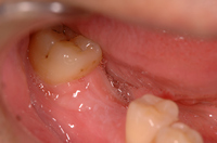 臼歯１本欠損症例
